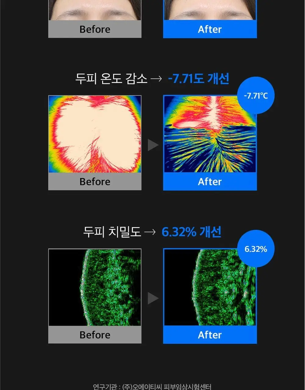 [탈모증상개선] 리필드 사이토카인 부스터 프로 70ml 단품/기획 2종 택1 상세페이지 18